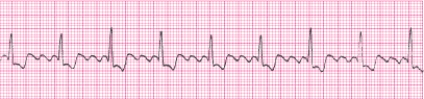 <strong>P waves in this rhythm strip _____. </strong> A) occur regularly B) are not identifiable; fibrillatory waves are present C) are upright before every QRS complex D) are not identifiable; flutter waves are present