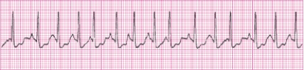 Identify the following rhythm (lead II): ____________________