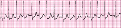 Identify the following rhythm (lead II): ____________________