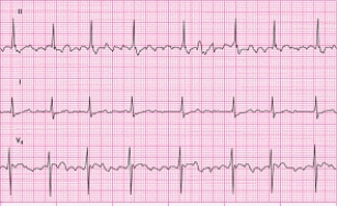 Identify the following rhythm: ____________________