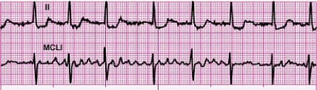 Identify the following rhythm: ____________________