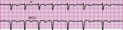 Identify the following rhythm: ____________________