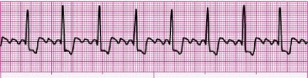 Identify the following rhythm: ____________________