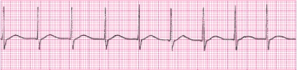 <strong>Identify the following rhythm (lead II). </strong> A) Accelerated junctional rhythm B) Sinus rhythm C) Junctional rhythm D) Sinus arrhythmia