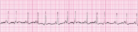 <strong>Identify the following rhythm (lead II). </strong> A) Sinus arrhythmia B) Sinus rhythm with junctional escape beats C) Sinus tachycardia with premature atrial complexes D) Sinus tachycardia with premature junctional complexes