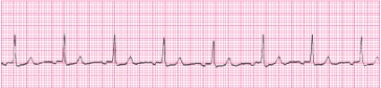 Identify the following rhythm (lead II): ____________________
