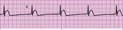 Identify the following rhythm: ____________________