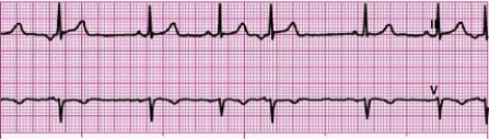 Identify the following rhythm: ____________________