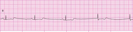 Identify the following rhythm: ____________________