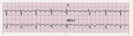 Identify the following rhythm: ____________________