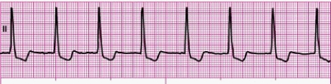 Identify the following rhythm: ____________________