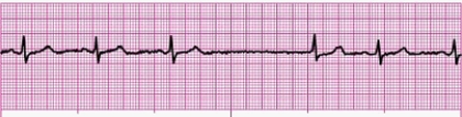 Identify the following rhythm (lead II): ____________________