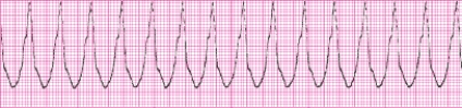 Identify the following rhythm (lead II): ____________________  <div style=padding-top: 35px> 