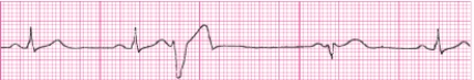 Identify the following rhythm (lead II): ____________________  <div style=padding-top: 35px> 