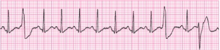 Identify the following rhythm (lead II): ____________________  <div style=padding-top: 35px> 