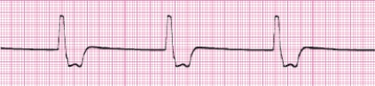 Identify the following rhythm (lead II): ____________________  <div style=padding-top: 35px> 