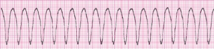 Identify the following rhythm (lead II): ____________________  <div style=padding-top: 35px> 