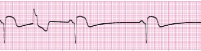 Identify the following rhythm (lead II): ____________________  <div style=padding-top: 35px> 