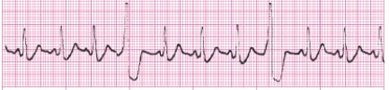 Identify the following rhythm (lead II): ____________________  <div style=padding-top: 35px> 