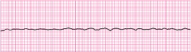 Identify the following rhythm (lead II): ____________________  <div style=padding-top: 35px> 