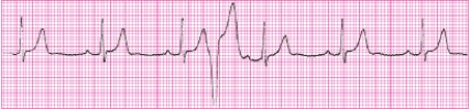 Identify the following rhythm (lead II): ____________________  <div style=padding-top: 35px> 
