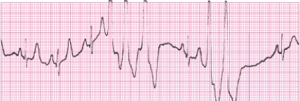 Identify the following rhythm (lead II): ____________________  <div style=padding-top: 35px> 