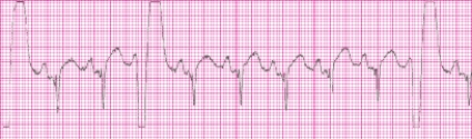 Identify the following rhythm (lead II): ____________________  <div style=padding-top: 35px> 