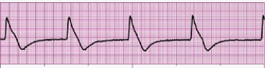 Identify the following rhythm (lead II): ____________________  <div style=padding-top: 35px> 