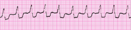 Identify the following rhythm (lead II): ____________________  <div style=padding-top: 35px> 