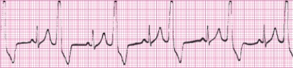 Identify the following rhythm (lead II): ____________________  <div style=padding-top: 35px> 