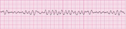 Identify the following rhythm (lead II): ____________________  <div style=padding-top: 35px> 