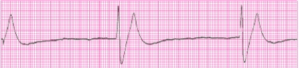 Identify the following rhythm (lead II): ____________________  <div style=padding-top: 35px> 