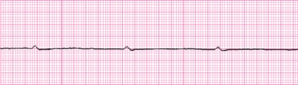 Identify the following rhythm (lead II): ____________________  <div style=padding-top: 35px> 