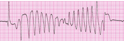 Identify the following rhythm (lead II): ____________________  <div style=padding-top: 35px> 