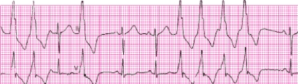 Identify the following rhythm: ____________________  <div style=padding-top: 35px> 