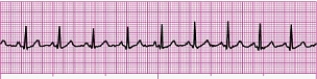 Identify the following rhythm (lead II): ____________________  <div style=padding-top: 35px> 