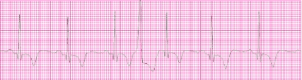 Identify the following rhythm (lead II): ____________________  <div style=padding-top: 35px> 
