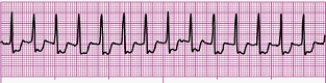 Identify the following rhythm (lead II): ____________________  <div style=padding-top: 35px> 