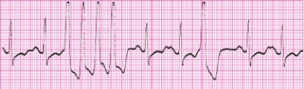 Identify the following rhythm (lead II): ____________________  <div style=padding-top: 35px> 