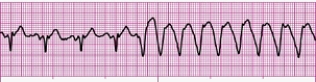 Identify the following rhythm (lead II): ____________________  <div style=padding-top: 35px> 