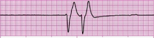Identify the following rhythm (lead II): ____________________  <div style=padding-top: 35px> 