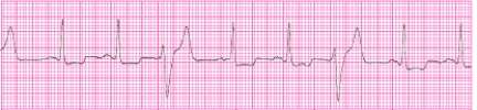 Identify the following rhythm (lead II): ____________________  <div style=padding-top: 35px> 