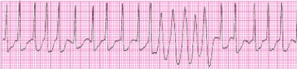 Identify the following rhythm (lead II): ____________________  <div style=padding-top: 35px> 
