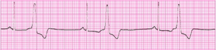 Identify the following rhythm (lead II): ____________________  <div style=padding-top: 35px> 