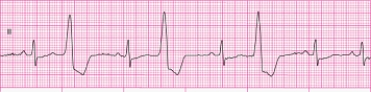 Identify the following rhythm: ____________________  <div style=padding-top: 35px> 