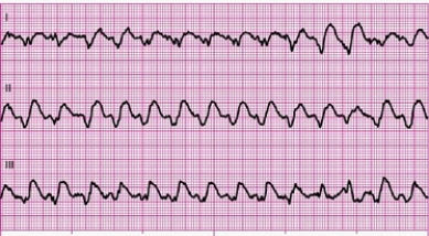 Identify the following rhythm: ____________________  <div style=padding-top: 35px> 