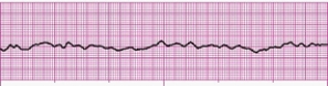 Identify the following rhythm (lead II): ____________________  <div style=padding-top: 35px> 