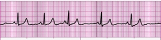 Identify the following rhythm (lead II): ____________________  <div style=padding-top: 35px> 
