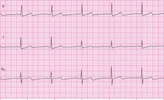 Identify the following rhythm: ____________________  <div style=padding-top: 35px> 
