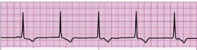 Identify the following rhythm (lead II): ____________________  <div style=padding-top: 35px> 